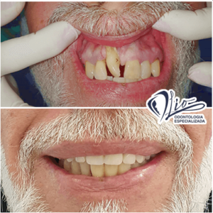 Dentes fixos sobre implantes sem precisar fazer enxerto ósseo