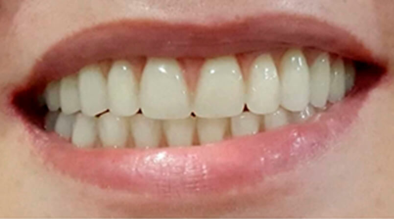 dentes fixos sobre implantes sem precisar fazer enxerto ósseo