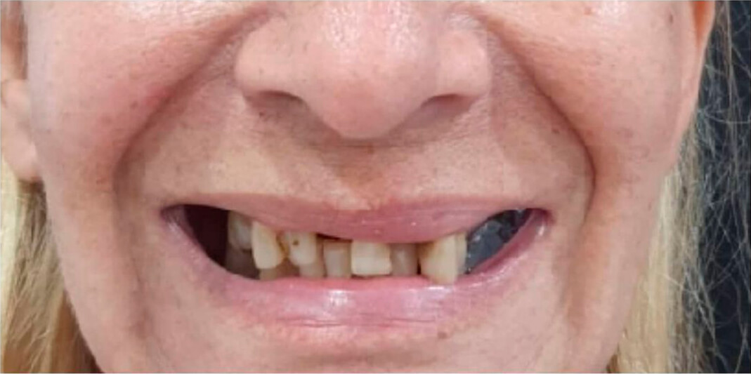 antes do implante dental